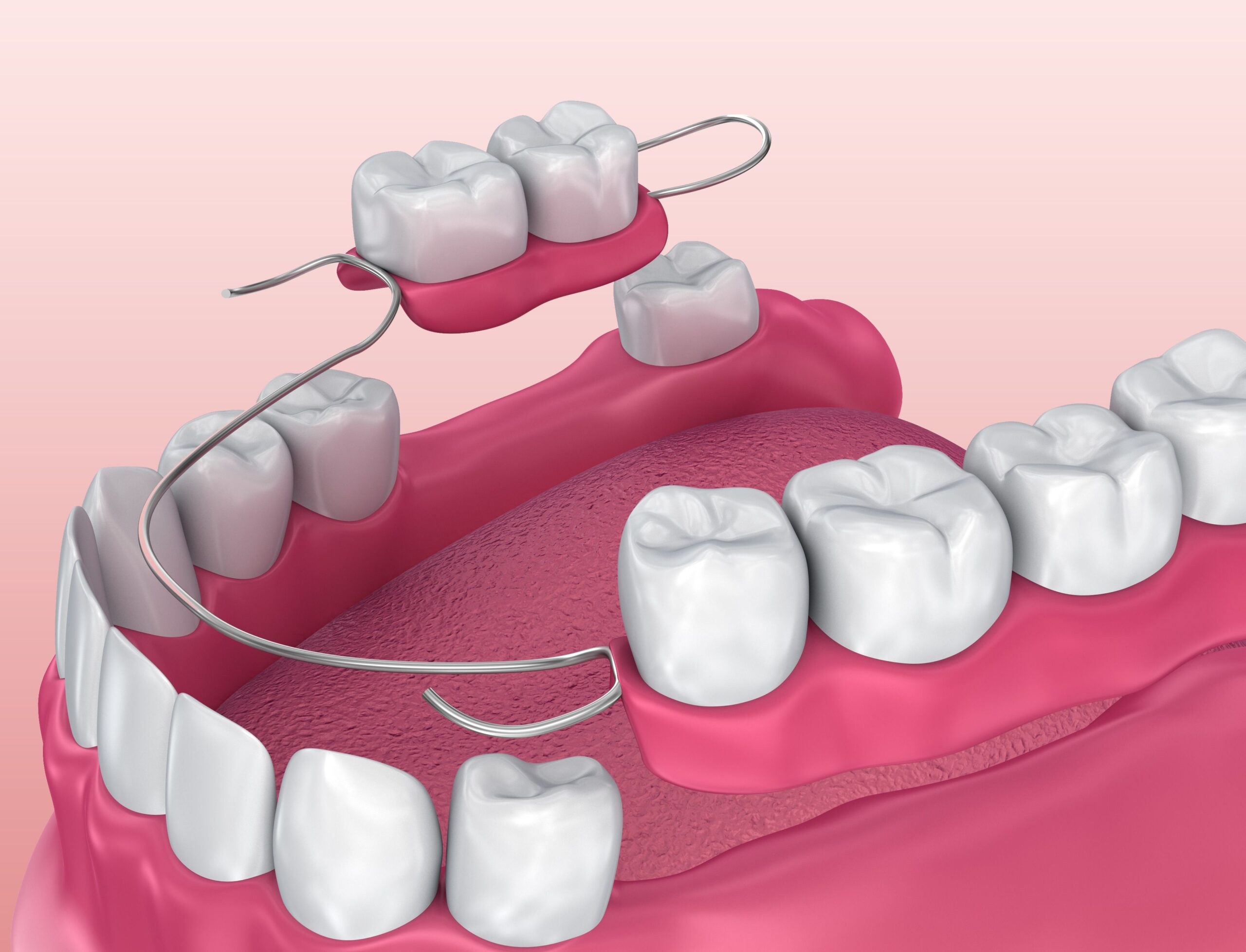 A Comprehensive Guide to Implant Dentistry in Houston