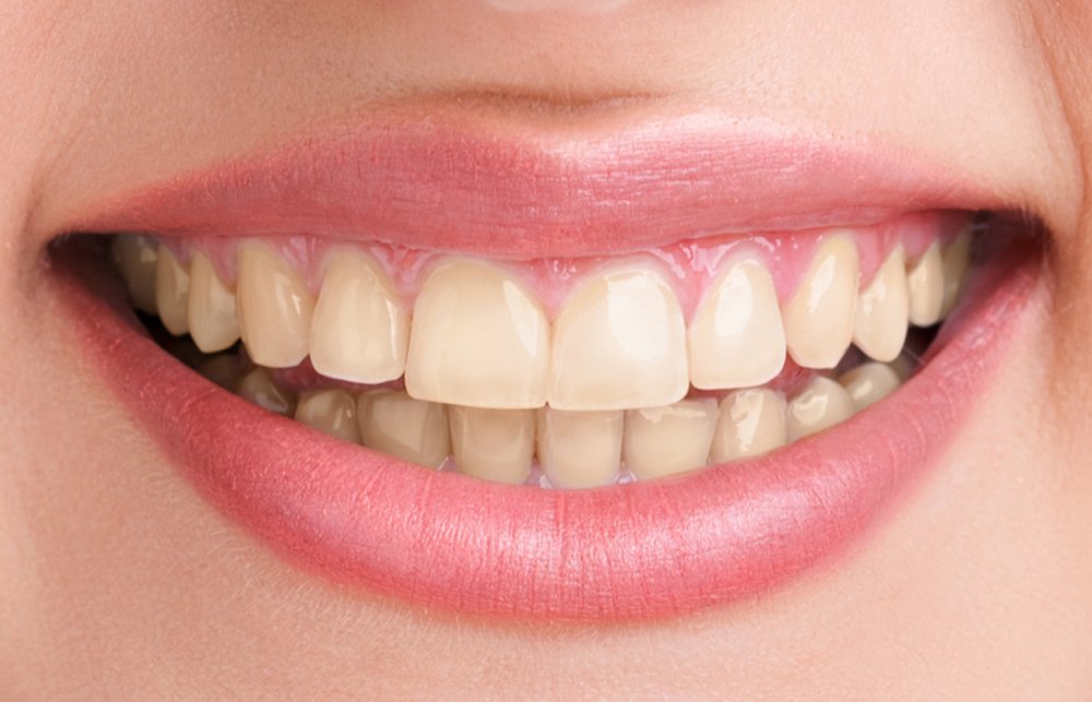 teeth-whitening treatment in Dubai