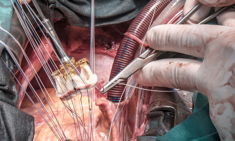 Transcatheter Heart Valve Replacement (THVR) Market – 2030