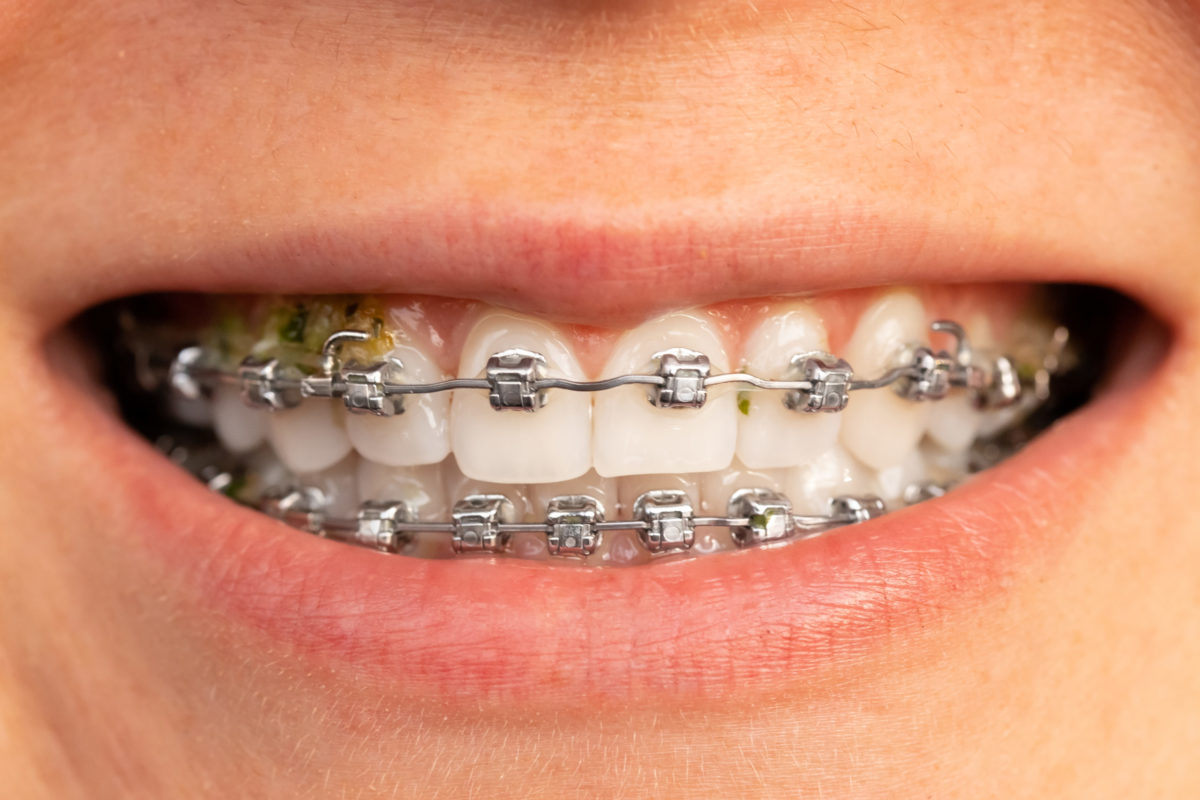 How Do Comfort Dental Braces Improve The Orthodontic Treatment Experience?