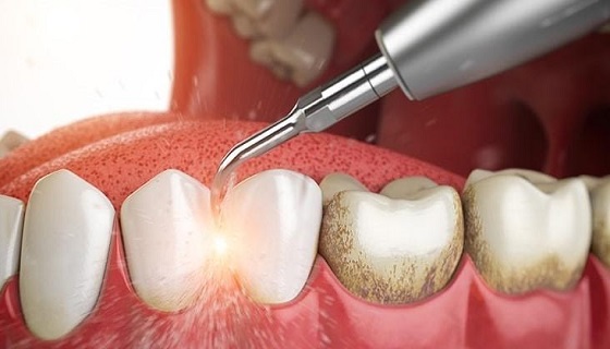 Tips on How to Remove Black Lines on Teeth at Home