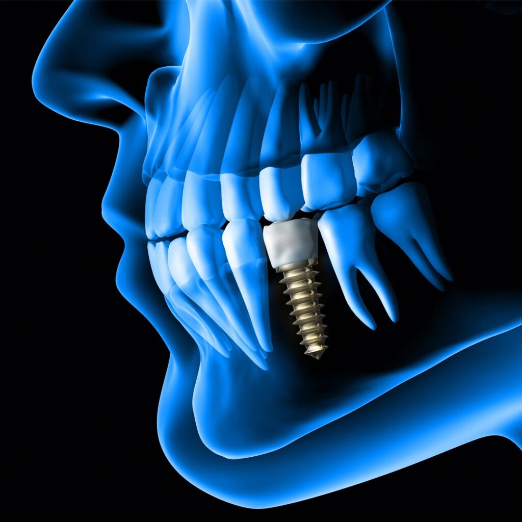 Dental Implants in Dubai: Restoring Your Smile with Expert Care