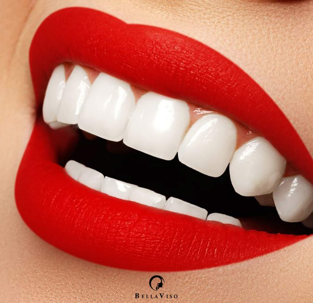 Best Dental Veneers Treatment in Dubai: Transform Your Smile with Confidence