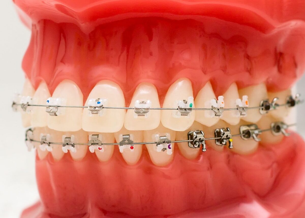Transforming Smiles: The Ultimate Guide For Fast Braces