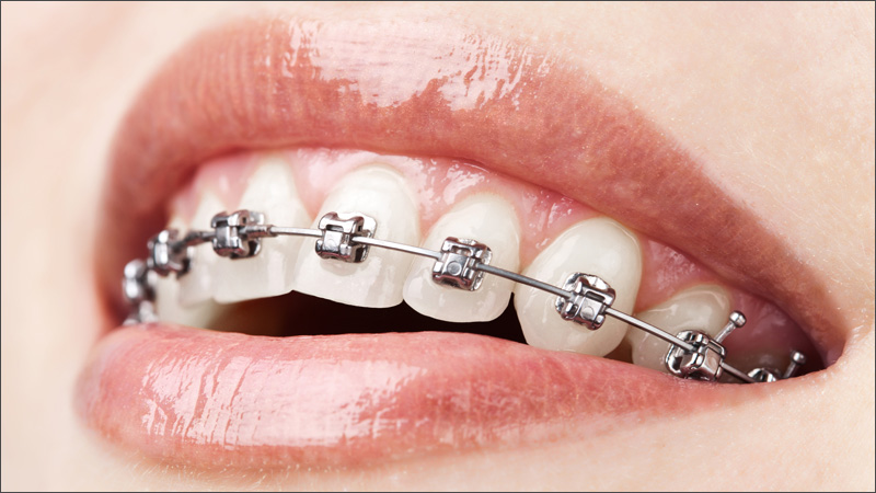 Transforming Smiles in Toronto: Your Guide to Orthodontic Care