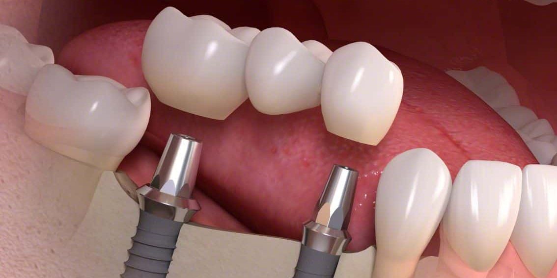 Dental Implants in London Ontario