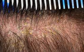 Consulting a Dermatologist: When to Seek Professional Help for Flaky Scalp