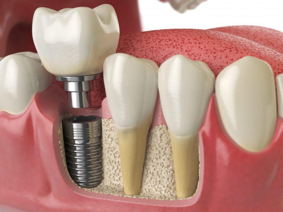 Are Dental Implants 77027 The Ideal Solution? Exploring The Expertise Of River Oaks Dentist 77027