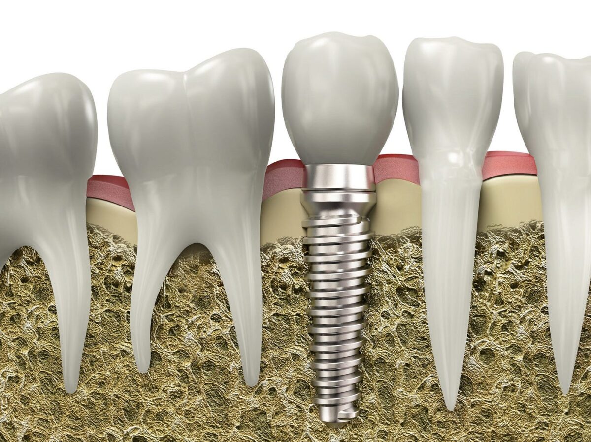 Searching For Restorative Dentistry Near Me? Discover The Benefits Of Dental Implants In Houston, TX?