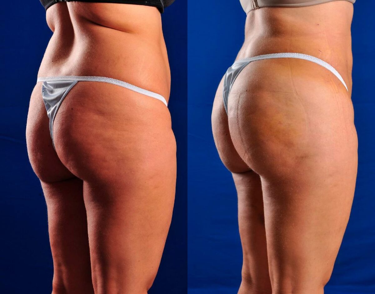 Is Belly Fat Removal Surgery The Answer? Explore Arm Liposuction Before And After Transformations?