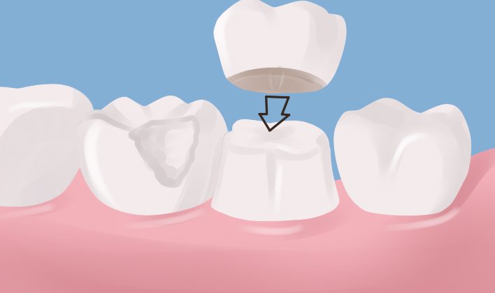 dental crown services