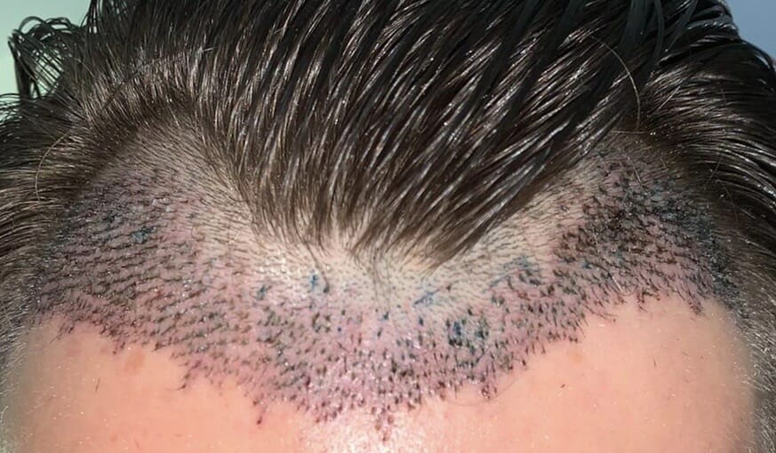 Enhance Your Appearance with a Hairline-Lowering Procedure
