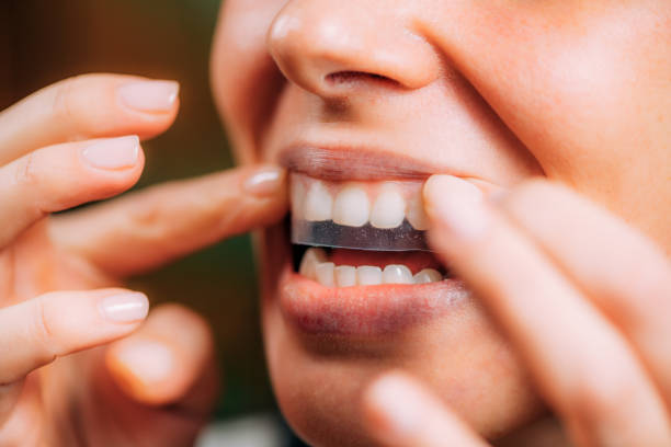 Riyadh’s Premier Teeth Whitening Services: A Sparkling Transformation