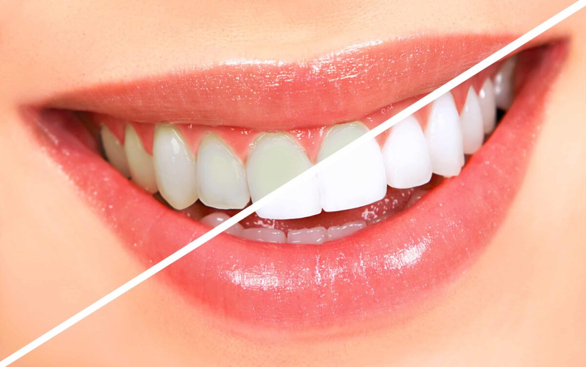 Whiten Your Smile In London Ontario With Teeth Whitening