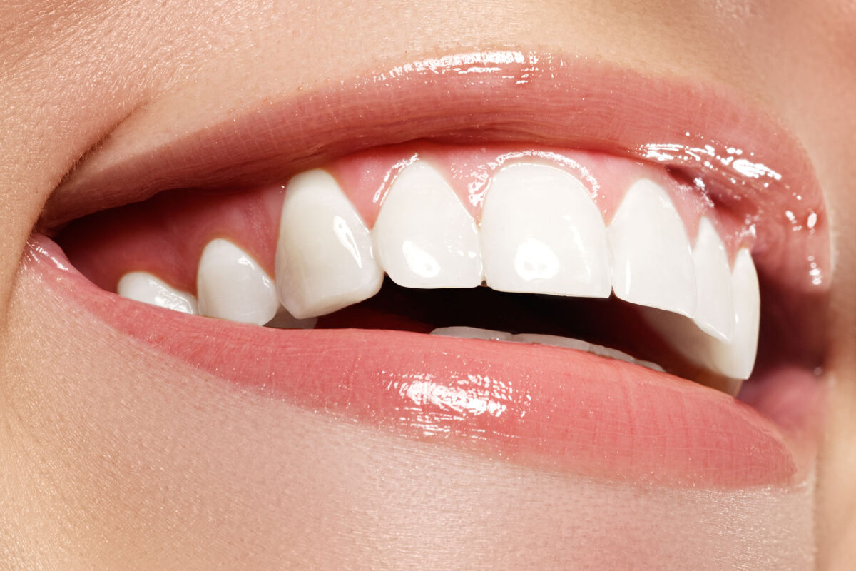 Finding Radiant Smiles: Understanding Teeth Whitening Services