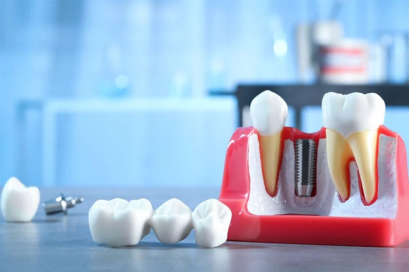 Dental Implants Benefits and Procedure 2024