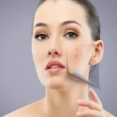 Unveiling Effective Solutions: Your Ultimate Guide to Acne Scar Treatment