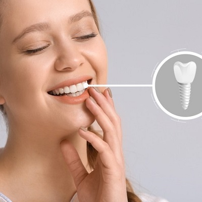 The Journey to Dental Implants: A Comprehensive Guide