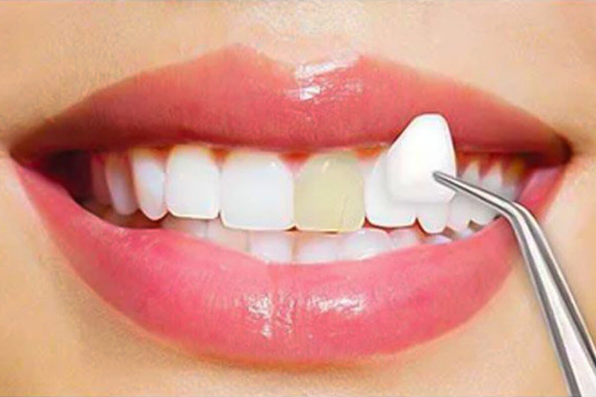 Enhancing Smiles-A Comprehensive Guide to Dental Veneers