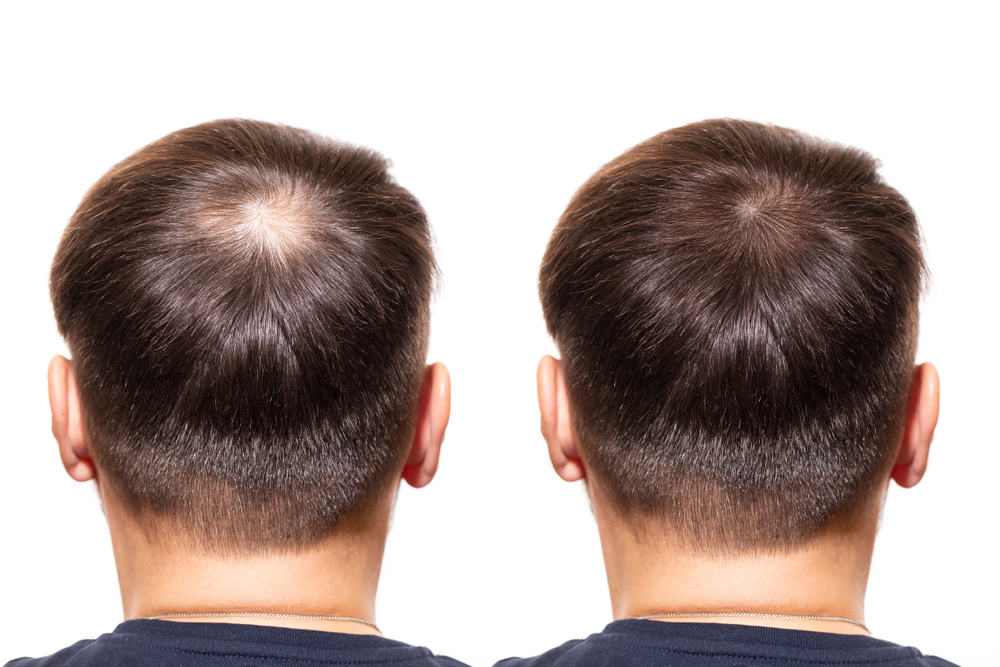 Hair Transplant FAQs: Answers to Common Questions