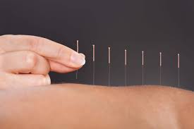 What You Need To Know About Getting Acupuncture