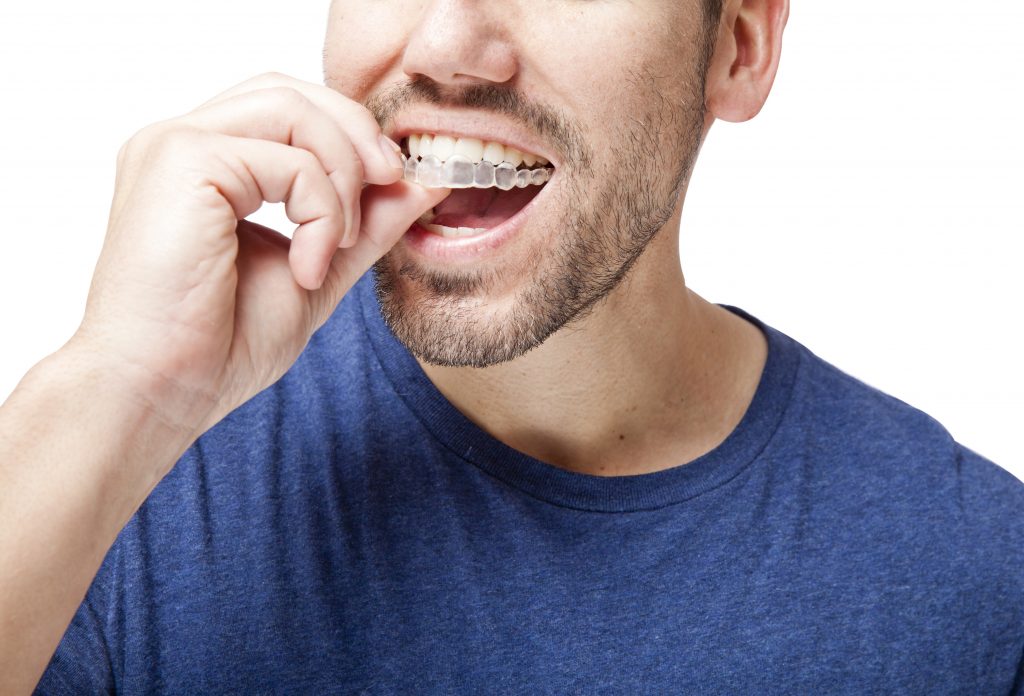 Invisalign Costs in Canada: What You Need to Know