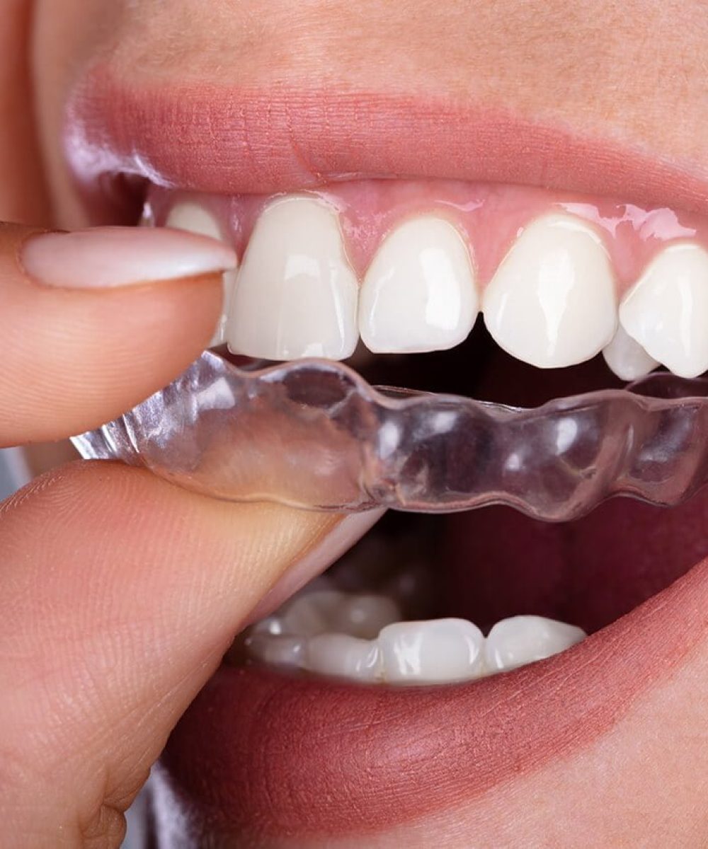 Invisalign Teen Which Is Right for Your Child? (Amma Naana Dental Clinic)
