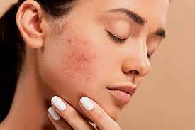 Renewing Radiance: Navigating Acne Scars Treatment in Islamabad