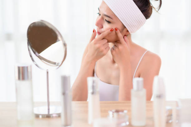 Which Treatment is Best For Acne?