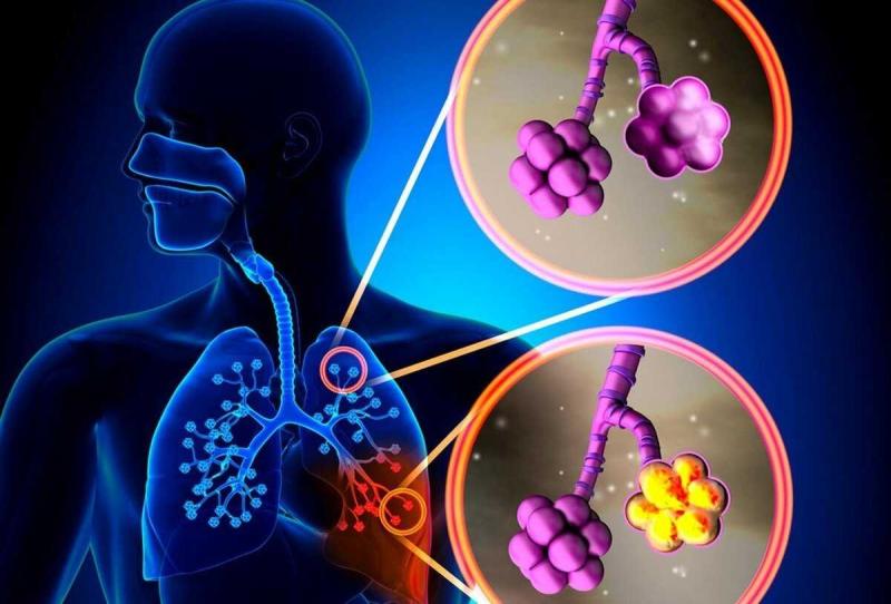 Pneumonia Testing Market Share, Industry Trends, Report and Forecast 2024-2032