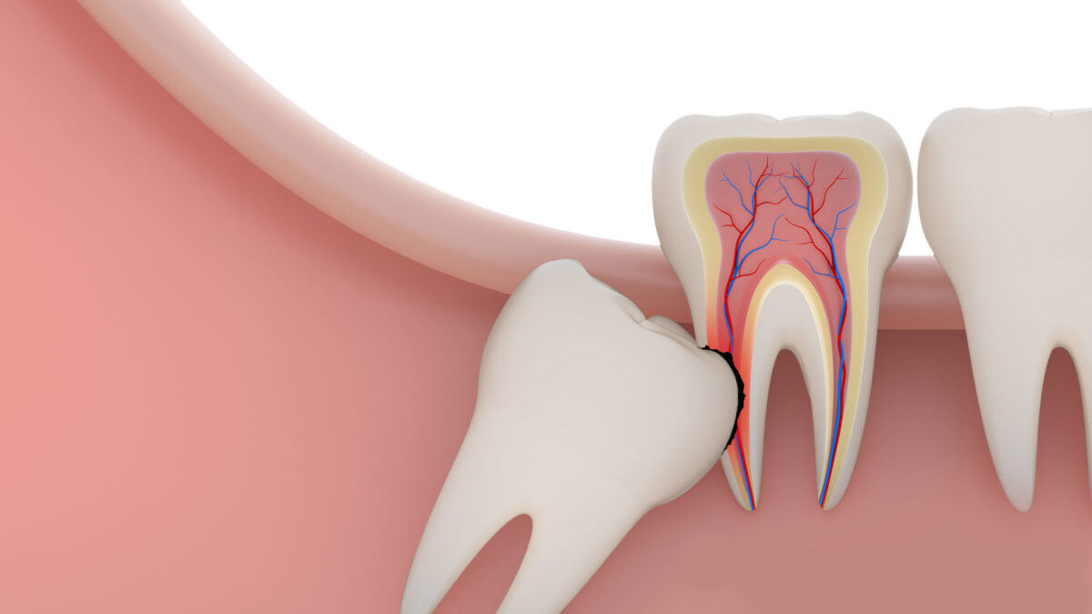 Comprehensive Guide To Wisdom Tooth Removal Services