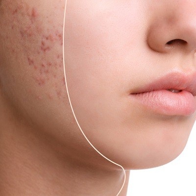 Transforming Your Skin: Effective Acne Scar Treatments in Islamabad