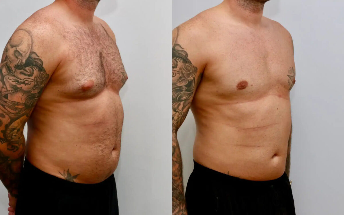 Choosing the Right Surgeon for Male Breast Reduction in Dubai