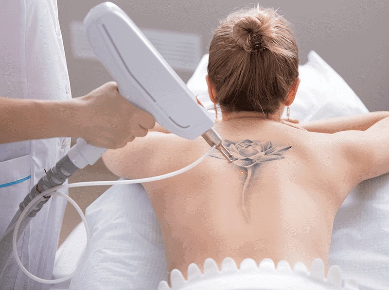 How to Prepare for Your Laser Tattoo Removal Session in Dubai