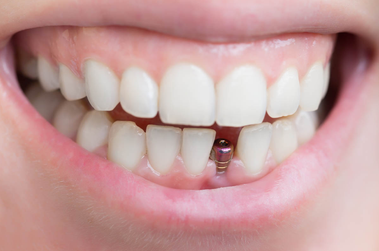 Who Should Explore the Possibility of Dental Implants?