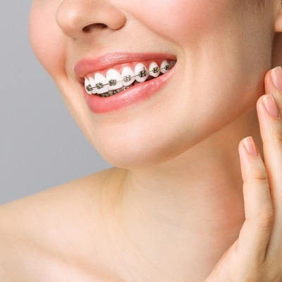 Transform Your Smile: A Comprehensive Guide to Dental Braces