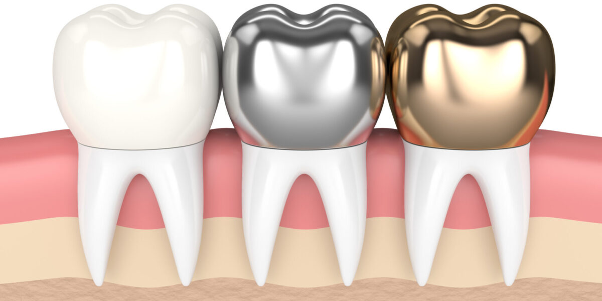 Utilize Dental Crown London Services To Get A Natural Appearance, 2024