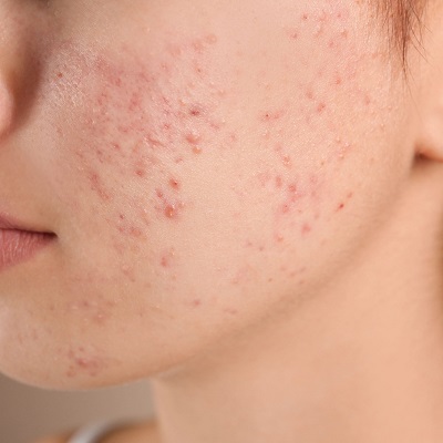 Can the Sun get rid of acne scars?