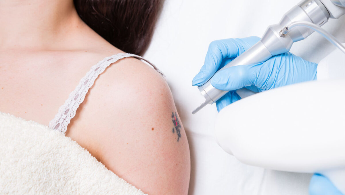 Unveiling the Secrets of Successful Laser Tattoo Removal
