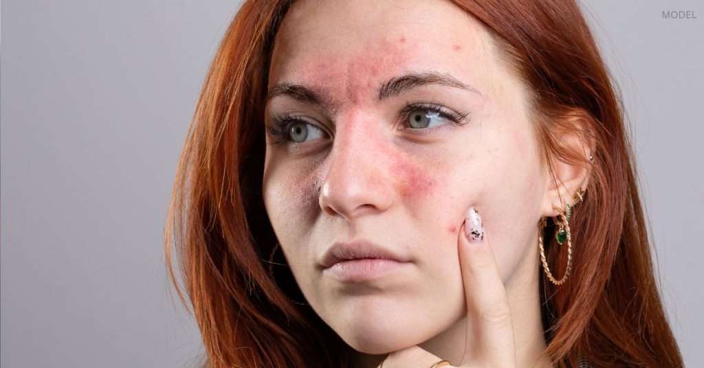 Rosacea Treatment in Dubai: What You Need to Know