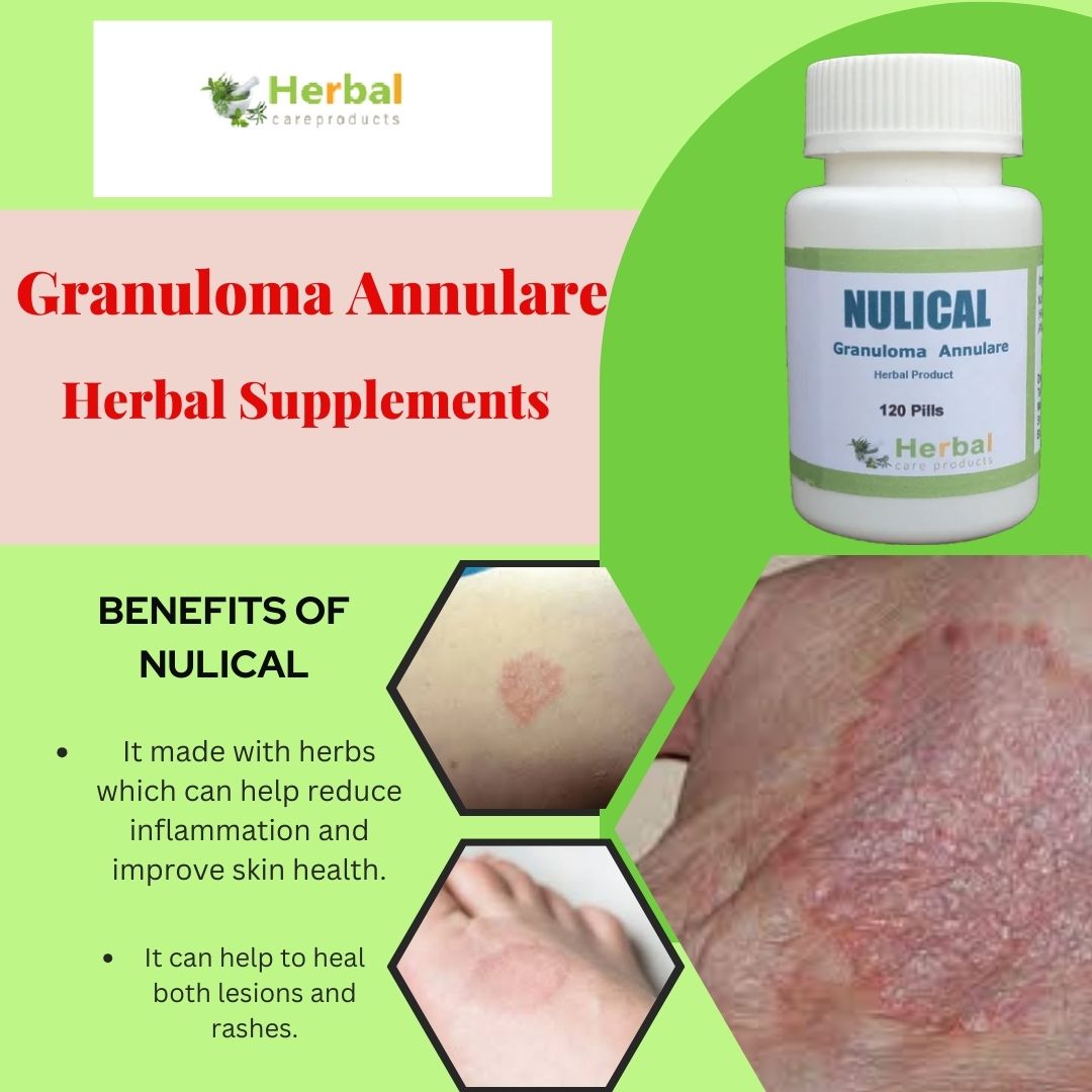 Granuloma Annulare Causes, Side Effects and Herbal Treatment