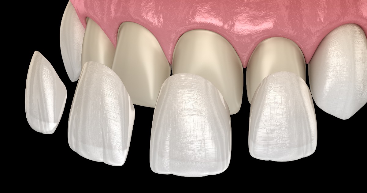 Step-by-Step Guide to Getting Dental Veneers Services