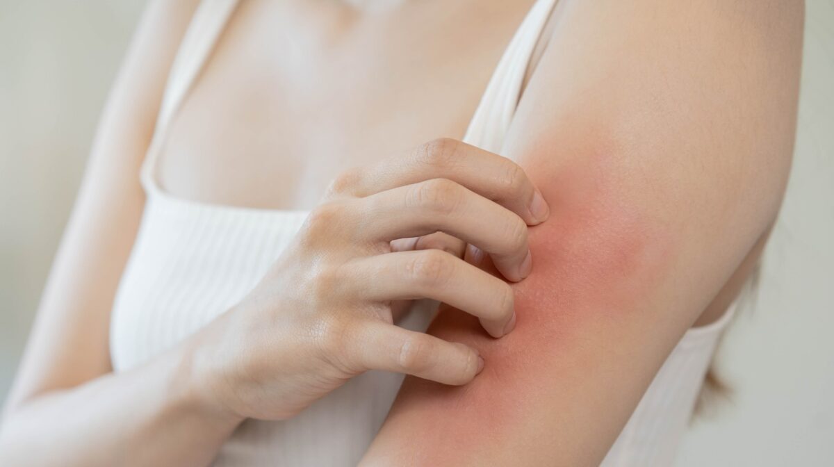 Is Eczema Contagious: Managing Eczema in Winter