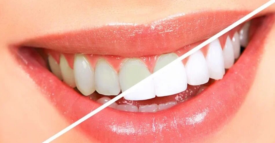 Teeth Whitening Services