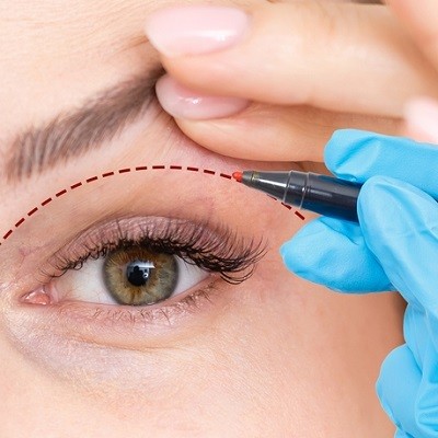 Your Guide to Eyelid Surgery Recovery in Islamabad