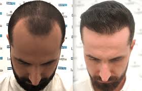 Hair Transplant in Dubaiii