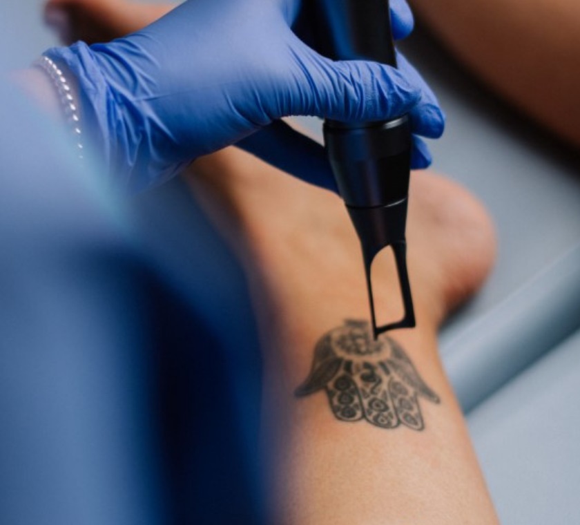 Dubai Laser Tattoo Removal: Regain Clear Skin