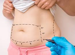 Is Tummy Tuck Safe? Understanding Risks and Safety Measures in Dubai