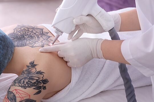 Restore Your Glow with Laser Tattoo Removal