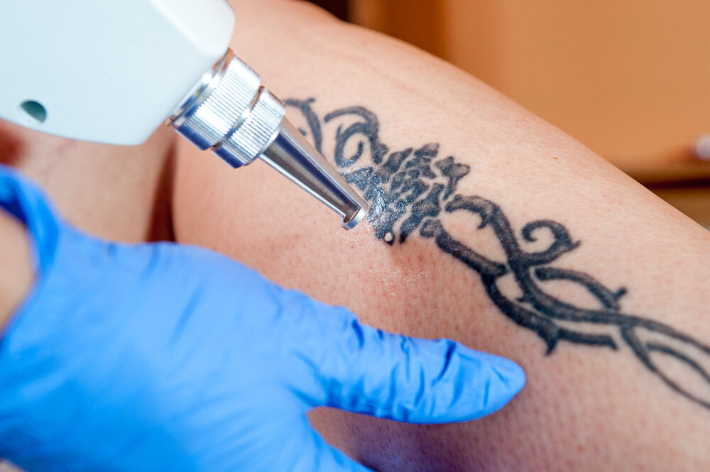 Say No to Regrets Laser Tattoo Removal